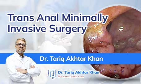 TransAnal Minimally Invasive Surgery